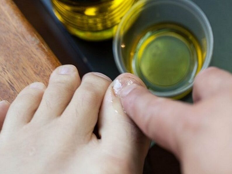 Tea tree oil for toenail fungal disease