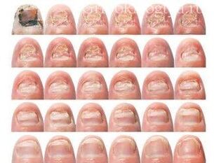Fungus gradually damages nails