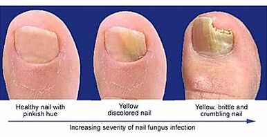 Nail fungus manifestations
