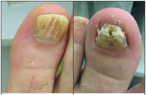 Normal fungal type