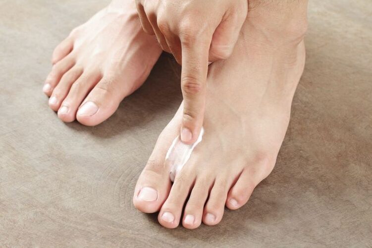 Application of antifungal cream on the skin of the feet