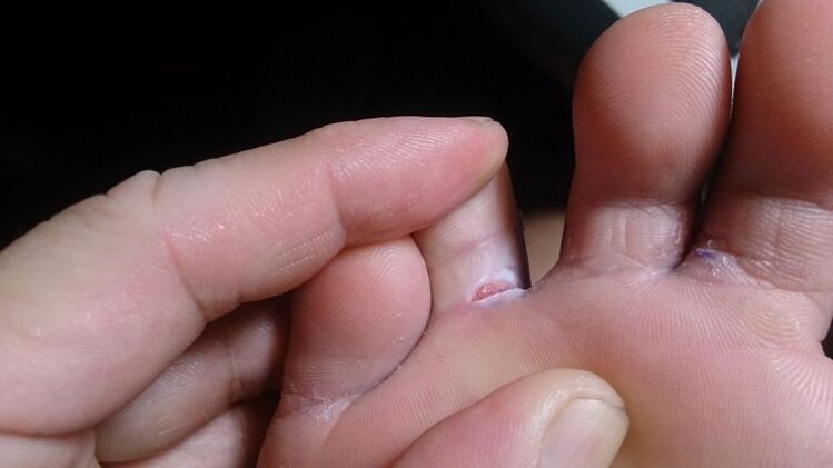Fungus between fingers