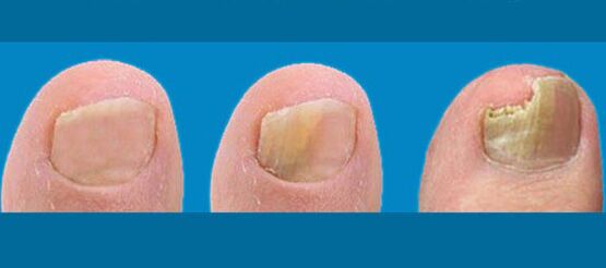 The stage of nail fungus