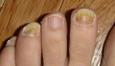 Causes of fungi appearing on nails