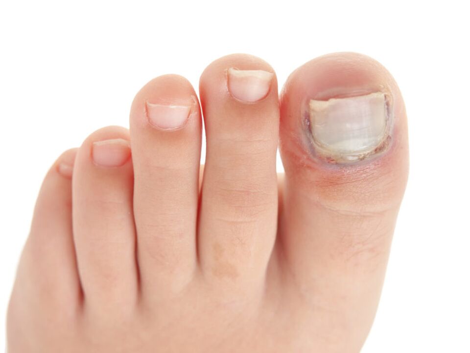 Damage the nail plate with fungus