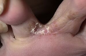 Gilbock between fingers