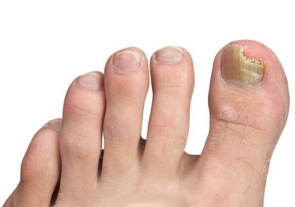 Causes of nail fungi