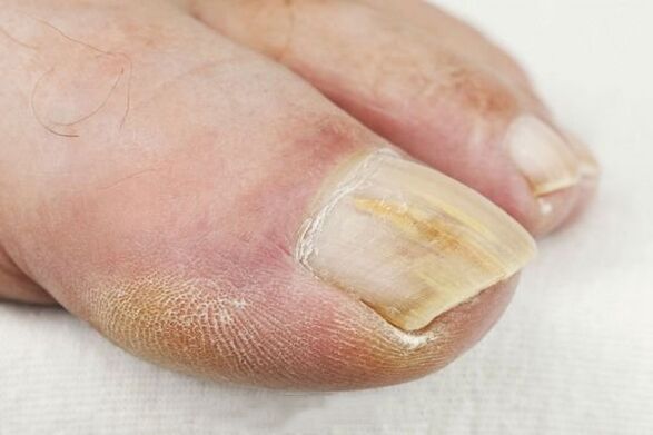 Consequences of fungal lesions