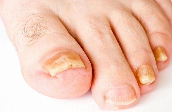 The form of nail fungus