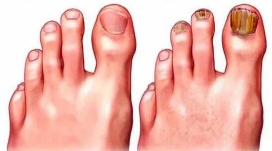 Healthy nails and fungus-affected nails