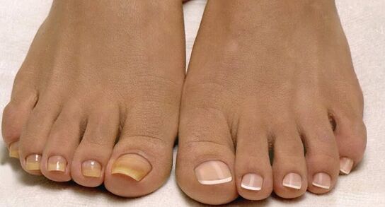Normal nails and onychomycosis