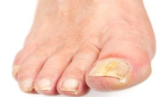 Yellowing of nails due to fungal infection