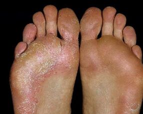 Foot fungal lesions