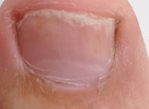 Early stage photos of onychomycosis