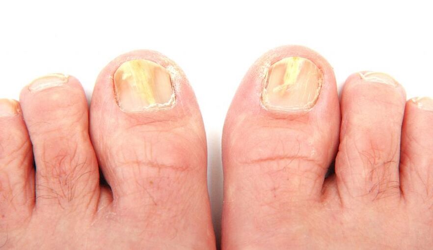 fungus on toenails