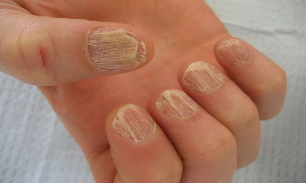 Advanced stages of nail curvature