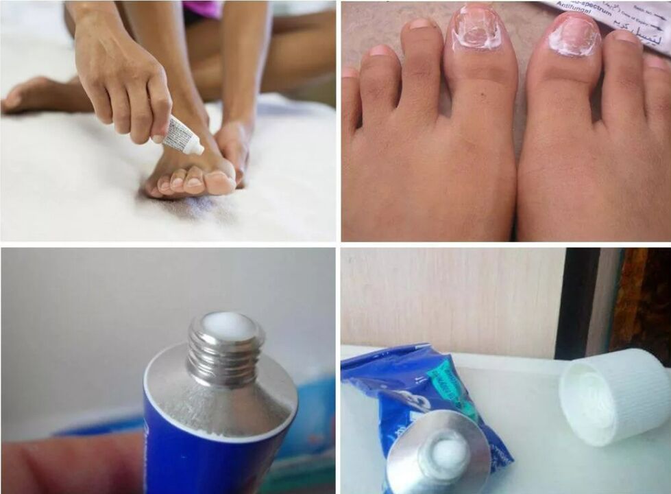 Medications to Treat Toenail Fungus