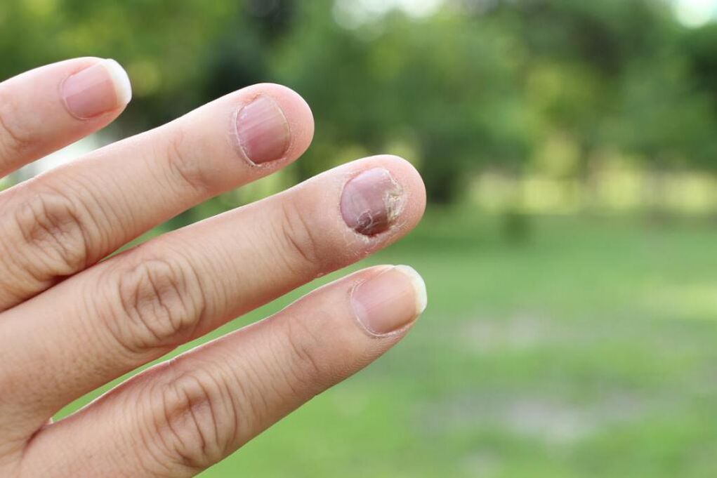 nail fungus
