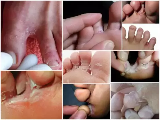 Symptoms of fungus between toes photo 2