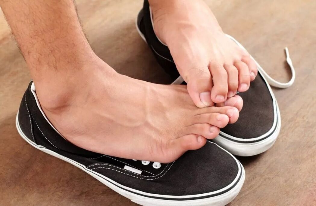 Itchy feet due to fungus between toes