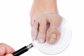Onychomycosis