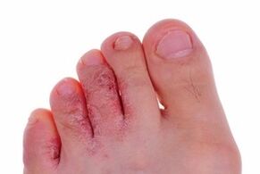 Skin lesions caused by fungus on legs