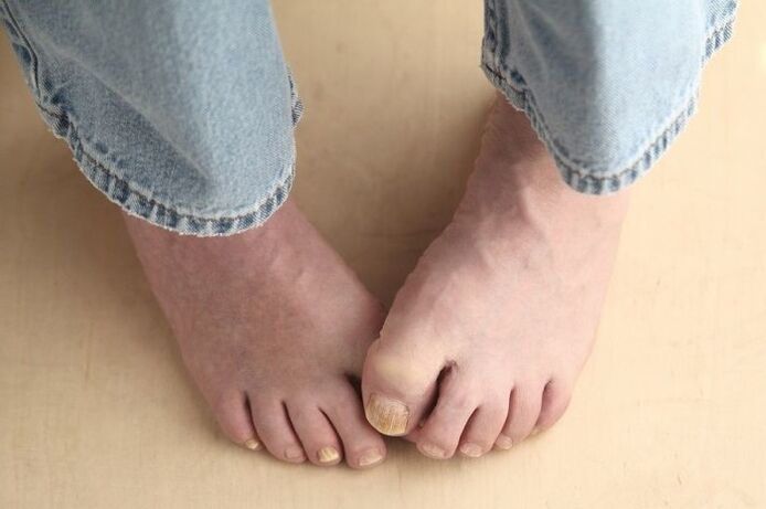 Feet with fungal nail infection