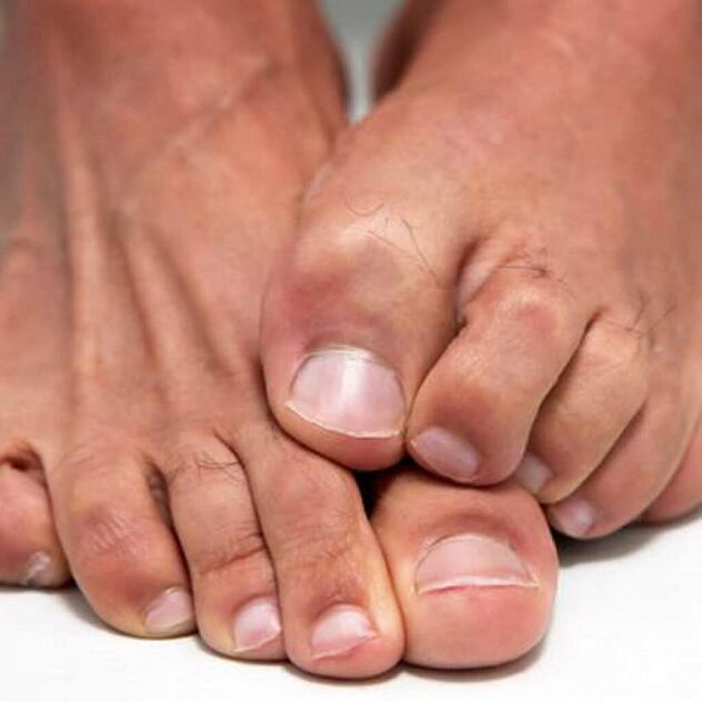 Fungus on feet can cause itching