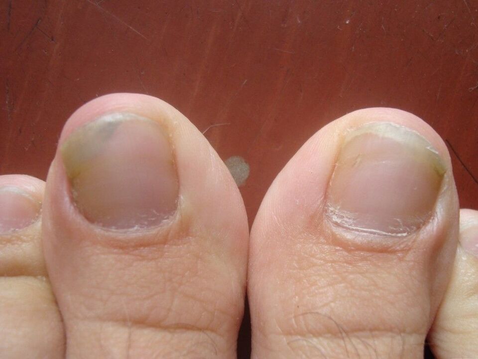 Symptoms and causes of onychomycosis