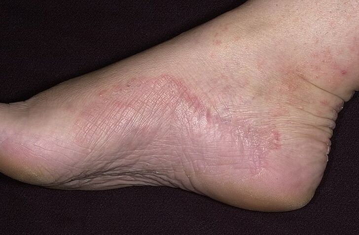 foot fungal infection