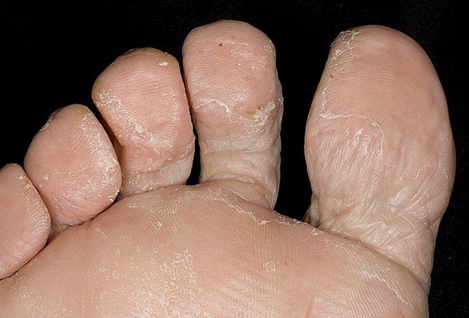 fungus between toes